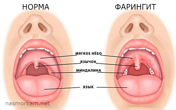 Болит горло слева при глотании и кашле