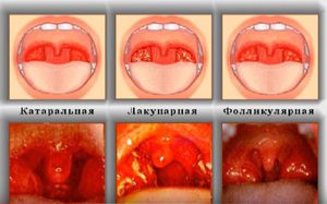 Как проявляется и лечится катаральная ангина у детей