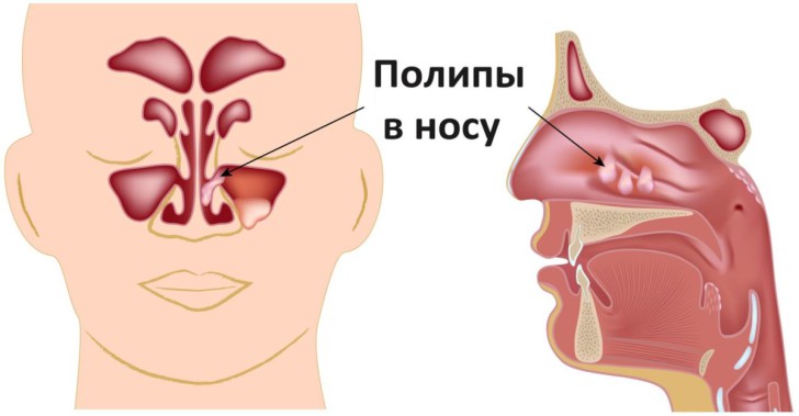 У ребенка закладывает нос во время сна и он не спит ночью, что делать