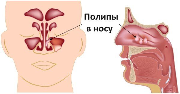 Назонекс спрей и капли в нос