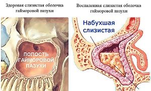 Какие признаки и как лечить катаральный синусит