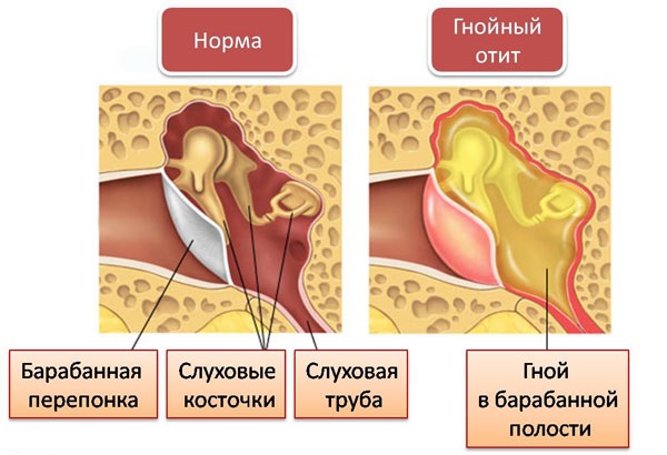 Иллюстрация изменений в ухе во время гнойного отита