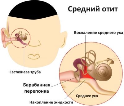 Лечение отита у детей основные виды отита и методы лечения