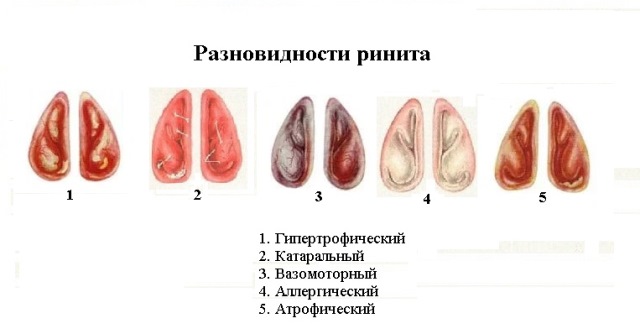 Вазомоторный ринит (идиопатический)