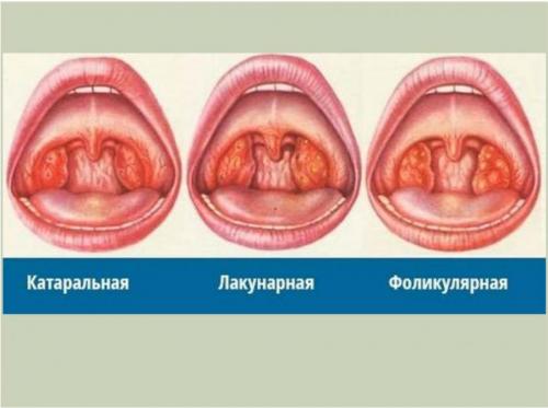 Виды ангины