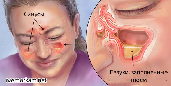 Острый пансинусит как вовремя заметить заболевание и предотвратить его развитие