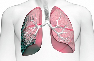 Пневмофиброз легких: что это такое, чем опасен и последствия, лечение народными средствами