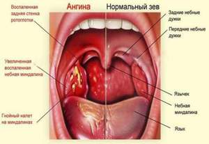 Как проявляется и лечится катаральная ангина у детей