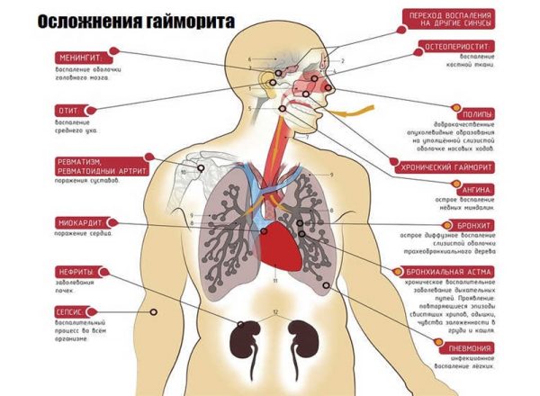 Осложнения гайморита