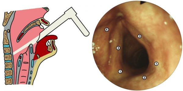 Непрямая ларингоскопия что это, кому и как ее проводят