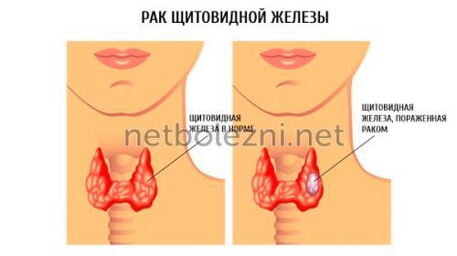 Причины охрипшего голоса, диагностика, что делать, народные методы лечения