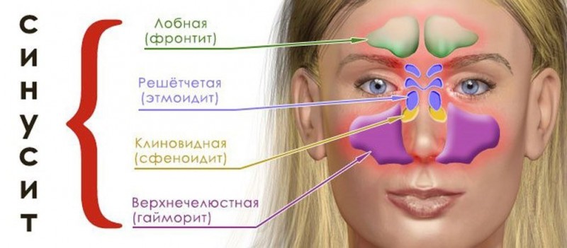 Определение и диагностика гайморита без снимка в домашних условиях