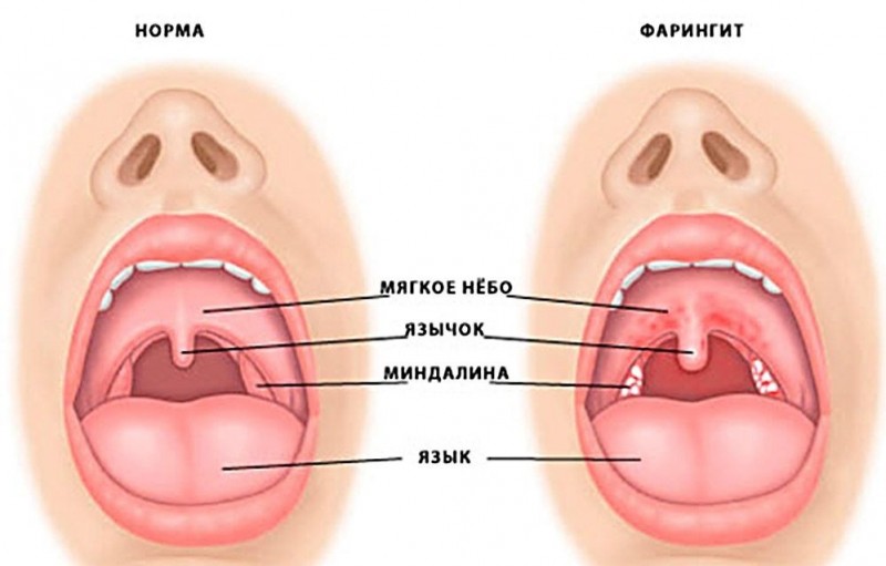 Почему появляются белые прыщи на задней стенке горла