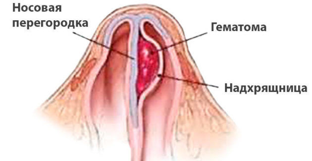 Септопластика носовой перегородки показания и противопоказания к проведению операции