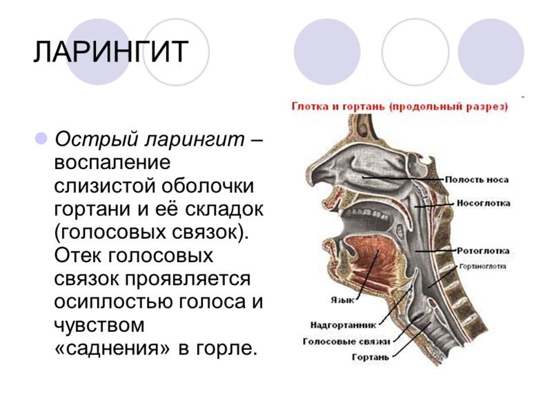 Что такое ларингит