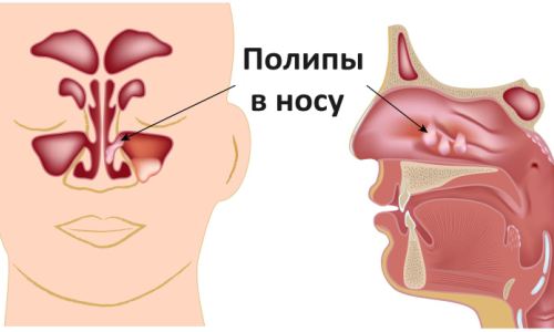 Промывание Кукушка при гайморите описание процедуры