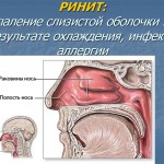 Причины и лечение атрофического ринита у взрослых