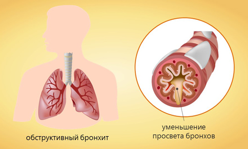 Бронхит у взрослых