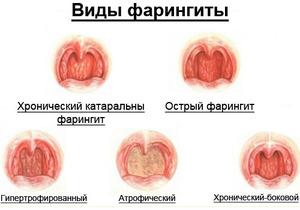 Как вылечить воспаление задней стенки горла