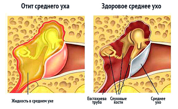 Продувание ушей в домашних условиях