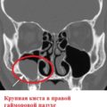 Обследование околоносовых пазух при помощи компьютерной томографии