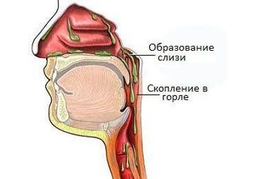 Почему скапливаются сопли в горле и что делать