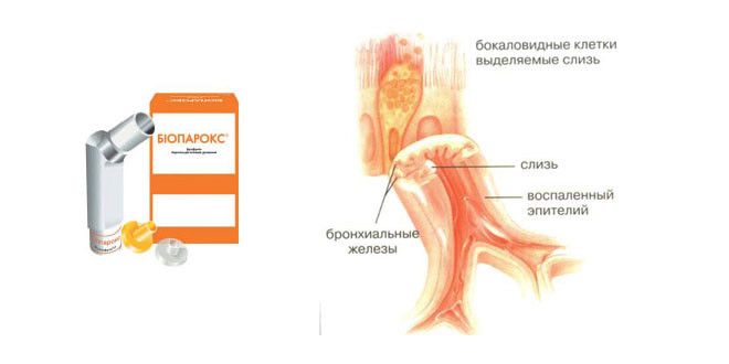 Симптомы энтеровирусного фарингита