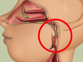 В носоглотке скапливается слизь мешает дышать
