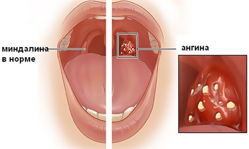 Чем и как лечить гнойную ангину у детей