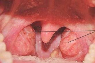 Воспаление носоглотки чем лечить в домашних условиях