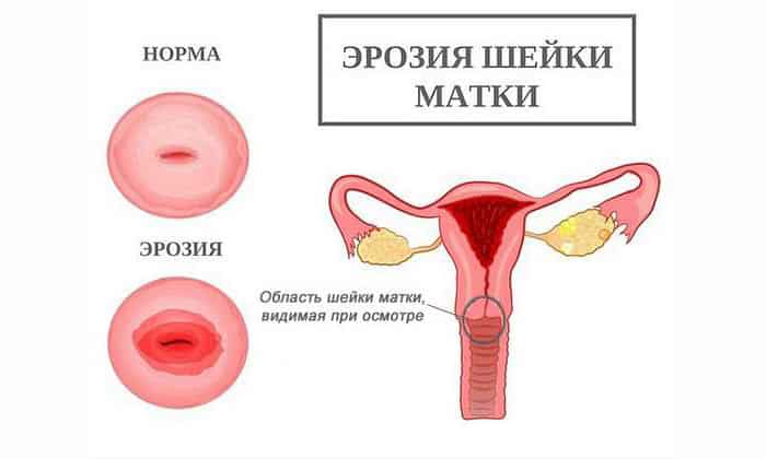 Использование сосательных таблеток от кашля