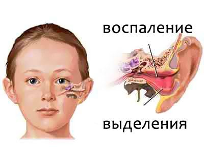 Чем лечить насморк у ребенка все что нужно знать