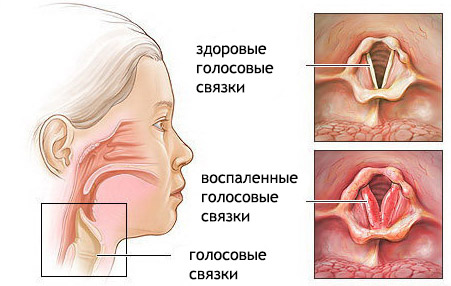 Острый ларинготрахеит у детей и взрослых - причины возникновения, симптомы, диагностика, препараты для лечения