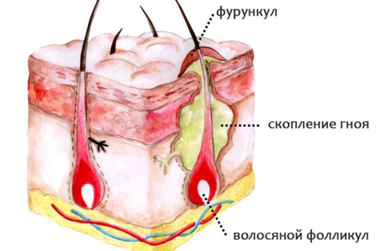 Шарик или шишка в мочке уха