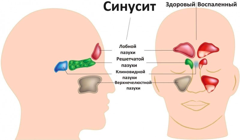 Синусит у взрослых симптомы и лечение в домашних условиях