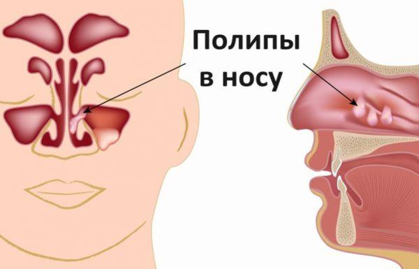 Самые эффективные средства от храпа в аптеках