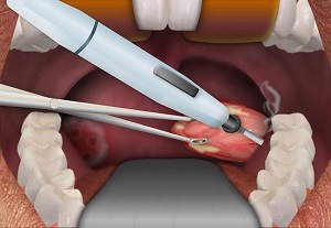 Процедура удаления миндалин при хроническом тонзиллите