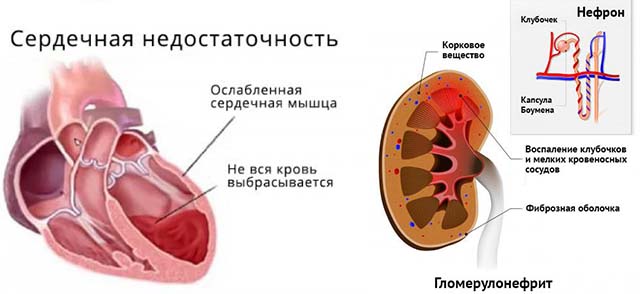 Симптомы, лечение и причины отека гортани у взрослых, оказание первой помощи