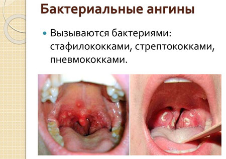 Почему появляются белые прыщи на задней стенке горла