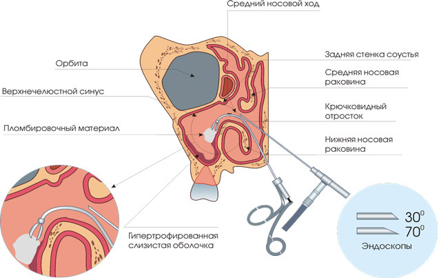 Гайморотомия