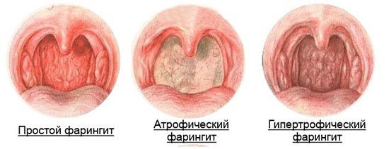 Чем лечить фарингит у взрослых