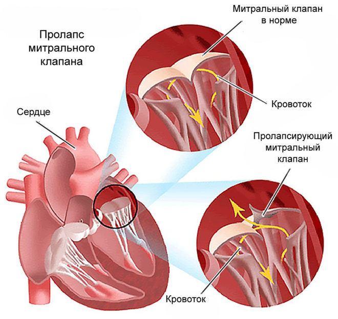 Скарлатина у ребёнка