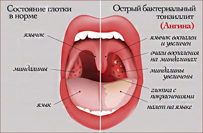 Заболевания горла и гортани симптомы и лечение болезни