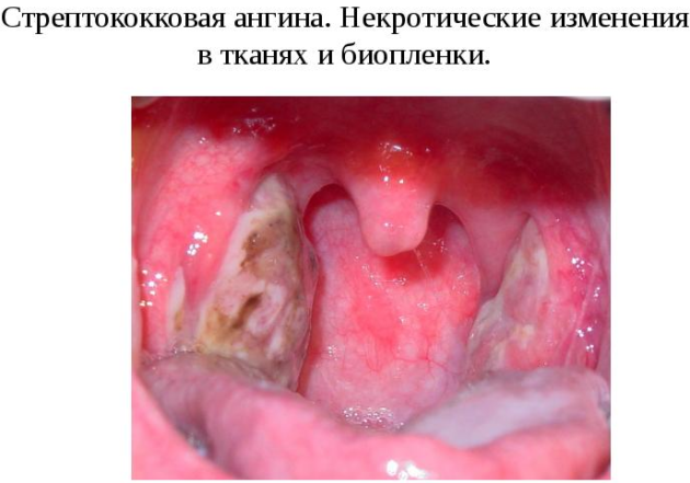 Стрептококковая ангина