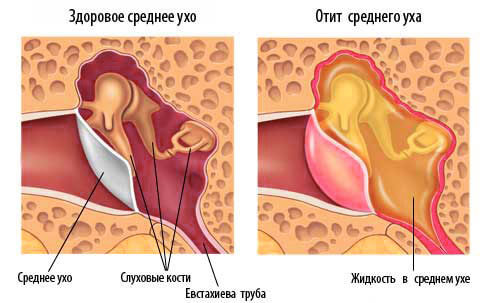 Лечение ушей перекисью водорода чистка, промывание, показания