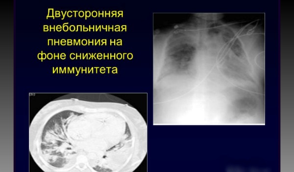 Двухсторонняя пневмония: разновидности и симптомы заболевания, когда показана госпитализация и методы терапии в разном возрасте, медикаментозное лечение и народная медицина