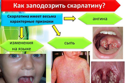 Белые и красные волдыри на задней стенке горла и миндалине